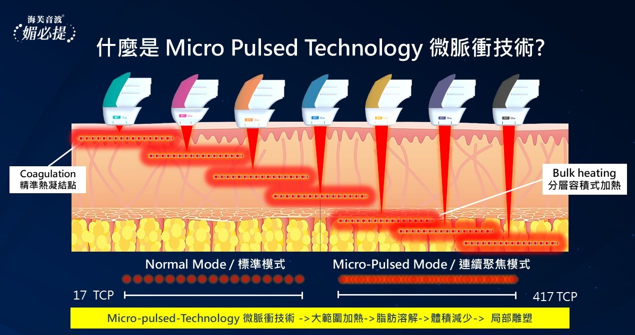 媚必提 Ultraformer MPT 2 探頭聚焦示意