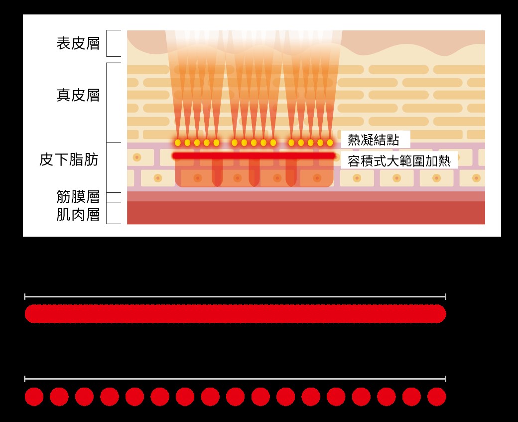 媚必提 Ultraformer MPT 1 皮膚層次圖
